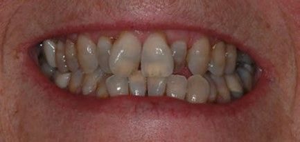 Smile makeover before and after result 1
