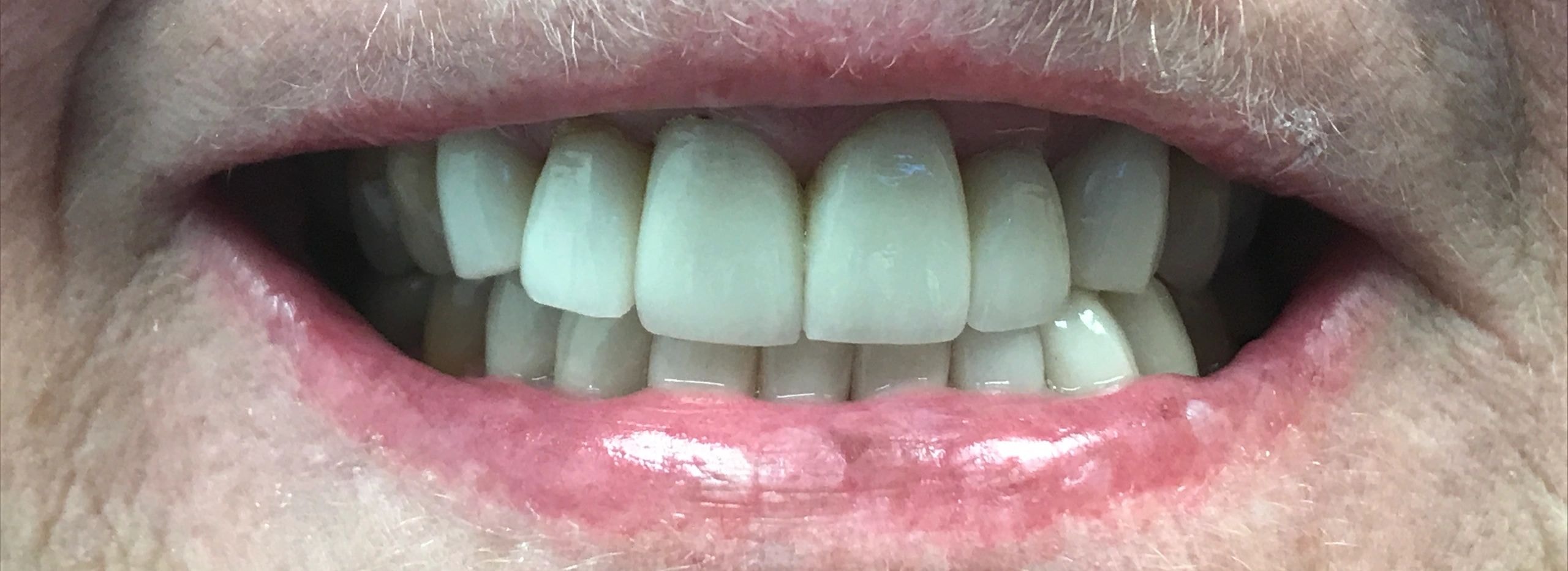 Smile makeover before and after result 2