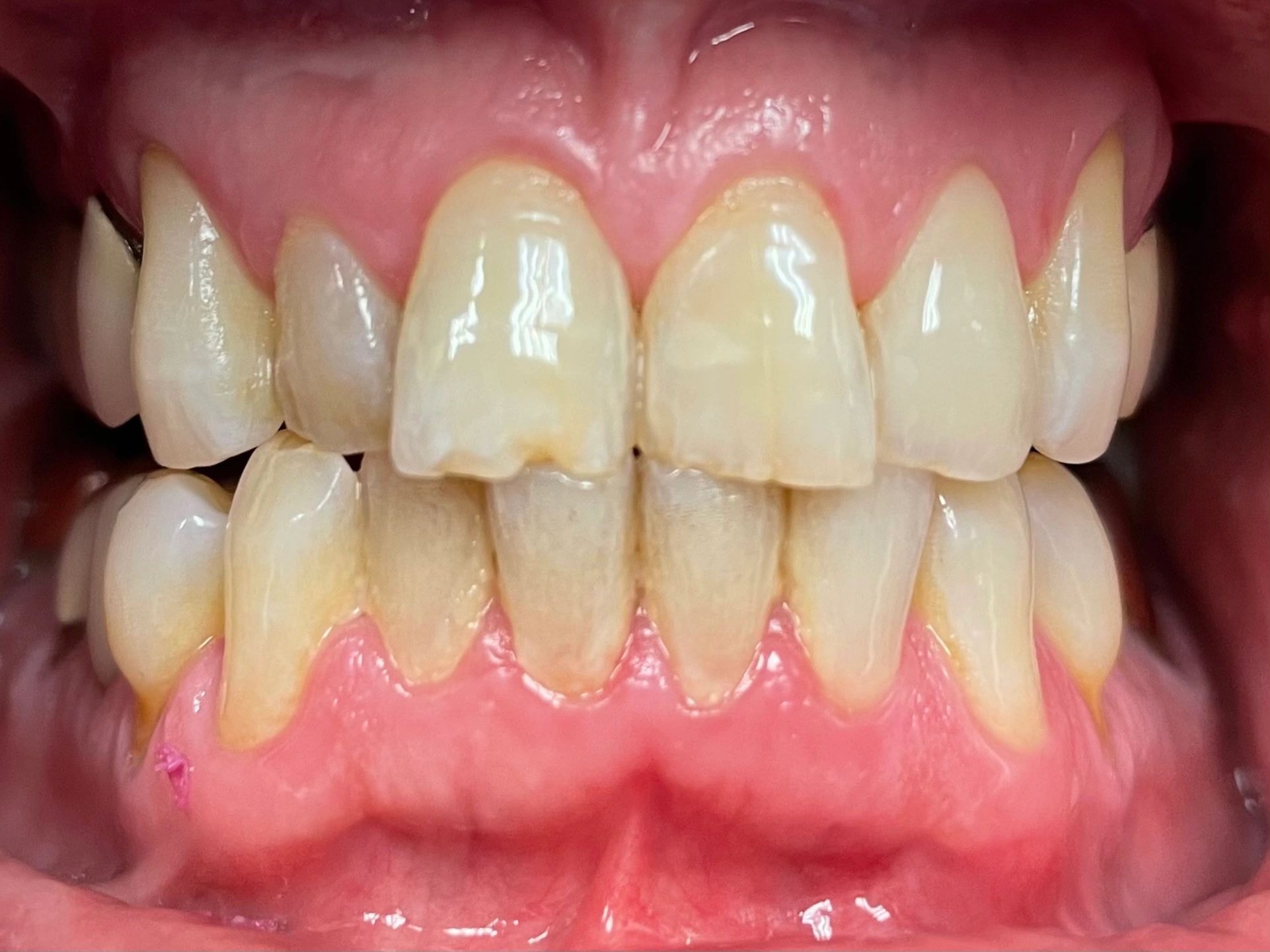 Smile makeover before and after result 3