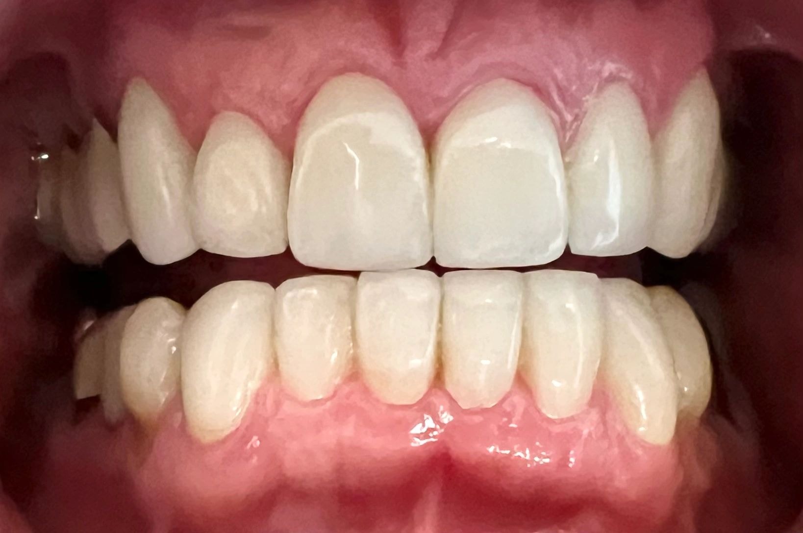 Smile makeover before and after result 4