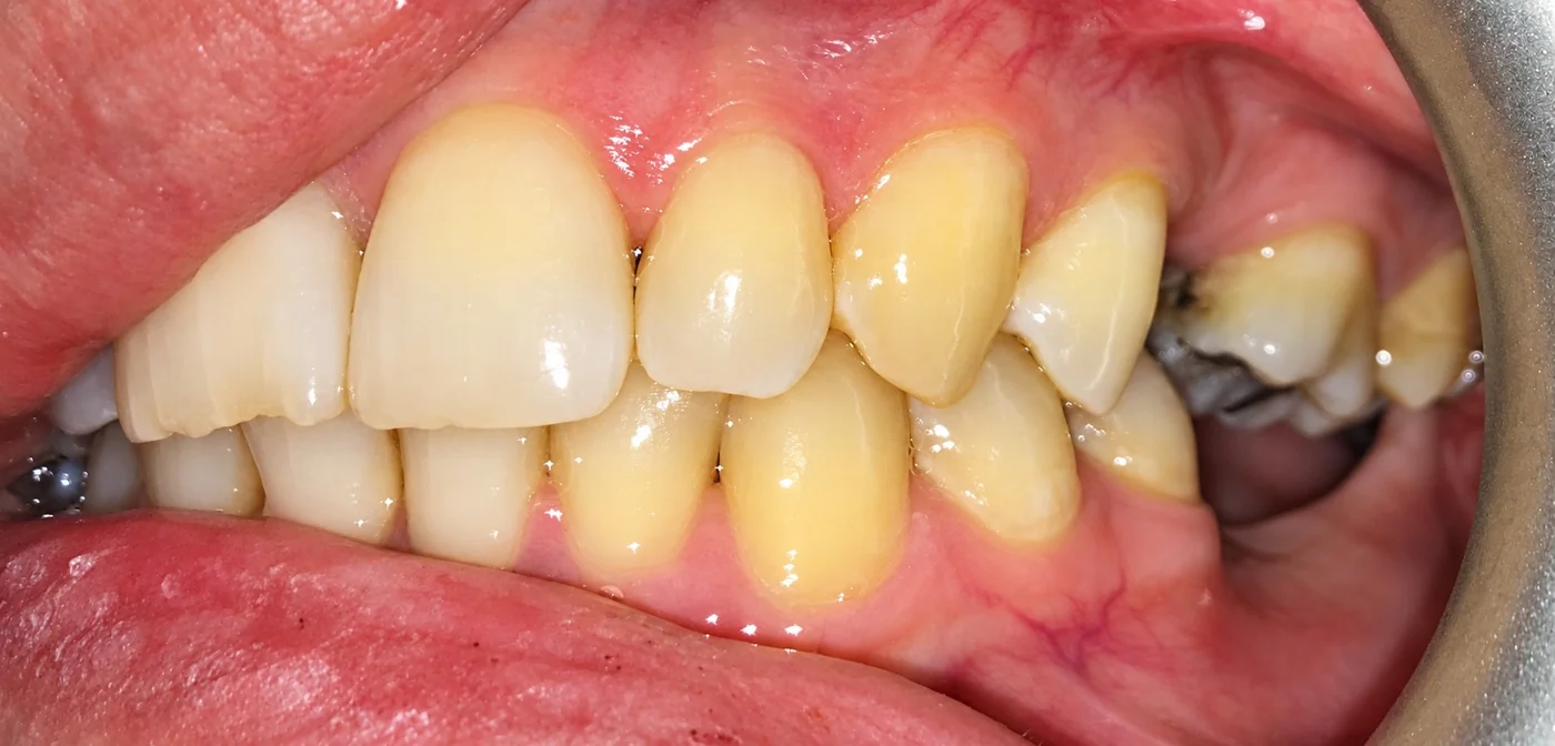 Close-up showing tooth condition prior to combined cosmetic treatment